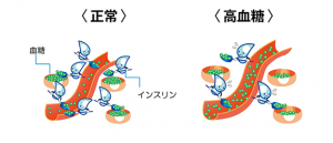糖尿病イラスト